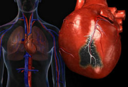 Лечение и причины кардиосклероза сердца